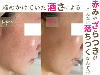 ソワンドビジュー(soin de bijew)/剥けないハーブピーリング