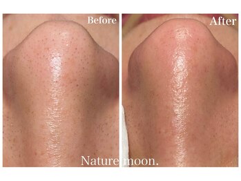 ナチュールムーン(Nature moon.)/毛穴洗浄