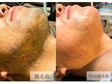 メンズアルファ/匠道ワックスヒゲ脱毛