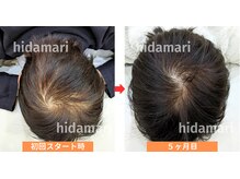 東武練馬ひだまり整骨院 鍼灸院/【育毛促進鍼】頭頂部の抜け毛
