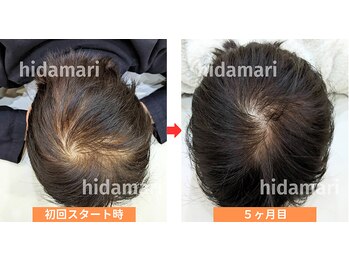 東武練馬ひだまり整骨院 鍼灸院/【育毛促進鍼】頭頂部の抜け毛