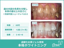 クレア(Crea)/【ホワイトニング症例写真】