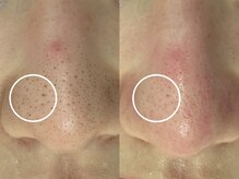 ラディアントモア(radiant more)/毛穴エクストラクション