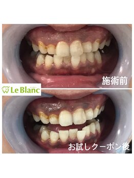 ルブラン 奈良店(Le Blanc)/不潔に見えてしまうタバコのヤニ