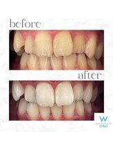 ホワイトニングショップ 広島店(WHITENING SHOP)/【ホワイトニング】Before After