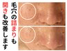 【2番人気】毛穴洗浄＆マッサージ＋レチノールマイクロニードル＋美容液導入