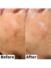 マハロハ 自由が丘(Mahaloha)/【シミケア・しわ改善施術】