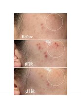 ヴィアージュ(Viage)/シミケア