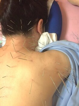 首・肩のつらさを改善したい