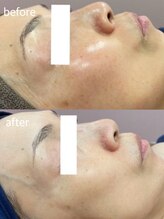 リベルテ(Liberte)/50代後半｜施術5回目