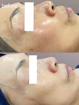 リベルテ(Liberte)/50代後半｜施術5回目