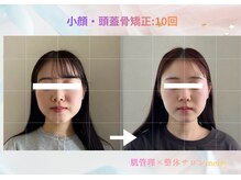 メリー 大和西大寺店(merry)/小顔・頭蓋骨矯正Before after★