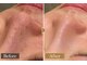 イーネオランジェ 阿佐ヶ谷店の写真/気になる毛穴のお悩み改善【毛穴洗浄+幹細胞】が超効果的◎施術後の違いを実感♪