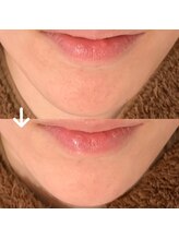 シャイン(Shine)/顎まで綺麗