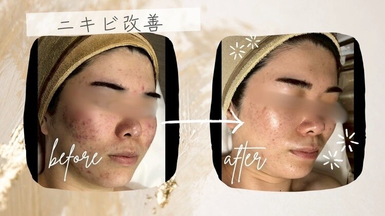 グリーンピールサロン ベレーザ(Salon)｜ホットペッパービューティー