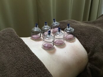健康堂整骨院 白楽院/カッピング