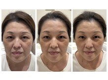 レディーススパアンドエステ テフ ホテル阪神(TeF)/40～50代　リフトケア