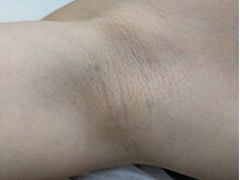 ブルーココア(BlueCocoa)/ワキ脱毛。