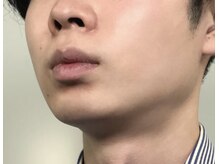 トータルビューティー air/メンズ脱毛