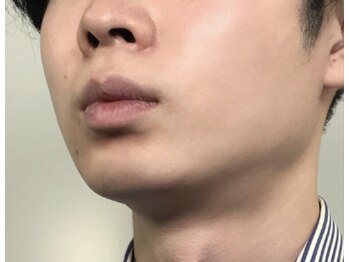 トータルビューティー air/メンズ脱毛