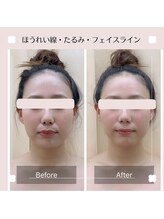 オリナサツキ(OlinaSatsuki)/ほうれい線が気になる方へ