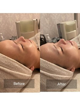 ステラグランデ(Stella grande)/古い角質でくすみがちな肌にも