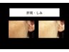 【人気NO2】シミ・しわ・くすみ 改善 ¥22.000→¥11.000