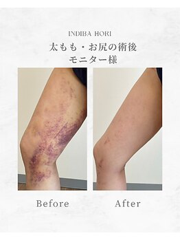 インディバ ホリ ナゴヤ ハニーズビューティー(INDIBA HORI NAGOYA Honey’s beauty)/名古屋インディバ