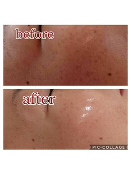 シェリモ(CHERIMO)/しみ改善ケア6回目の結果