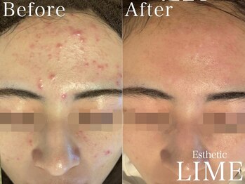 ライム 東銀座(LIME)/ハーブピーリング｜ニキビケア