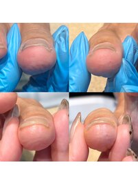 来店当日から巻き爪が緩和