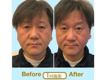 ア ニュームーン 京都烏丸店(a New Moon)/メンス小顔矯正ビフォーアフター