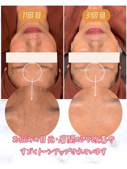 エステ ココ 荻窪店(Esthe CoCo)/目元/眉間