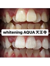 アクア 天王寺店(AQUA)/セルフホワイトニング効果