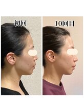 小顔22 ボルティ 本店(Bolty)/Before→After（10回）