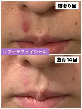 プリュネル(Prunelle)/プラズマシャワー