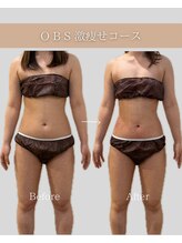 OBS新潟整骨院/新潟脂肪冷却症例数No,1