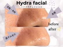 まつげ屋リュ( Ly)/ハイドラフェイシャル