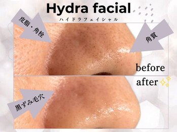 まつげ屋リュ( Ly)/ハイドラフェイシャル