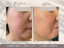 碧(ao)/肌質改善