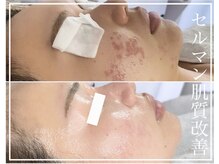 レイ(Rey)/肌トラブルも最速ケア