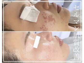 レイ(Rey)/肌トラブルも最速ケア