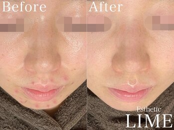 ライム 東銀座(LIME)/ハーブピーリング｜ニキビケア