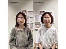 アネラ(ANERA)/小顔矯正&毛穴洗浄BeforeAfter