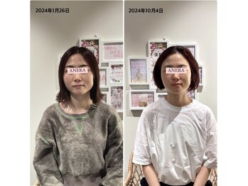 アネラ(ANERA)/小顔矯正&毛穴洗浄BeforeAfter
