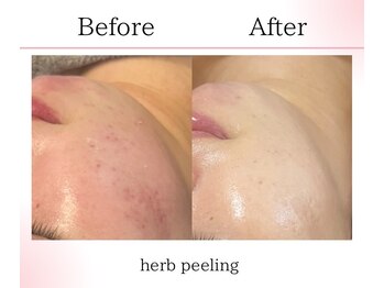 サロンツキ(salon tuki)/ハーブピーリング症例/徳島