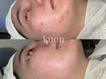 ルオン(Luon.)/ニキビケア/ハーブピーリング