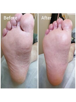 リゼラアンドコー 御茶ノ水店/《角質ケア》