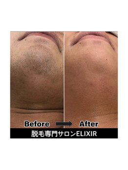 エリクサー 太田店(Elixir)/before after