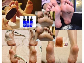 ビサンテ サロンの写真/角質ケア&特許,角質育成ケアで魚の目/たこ/足裏/踵/ツルプル美脚!脚美白も人気!梅雨,足臭スプレー◎
